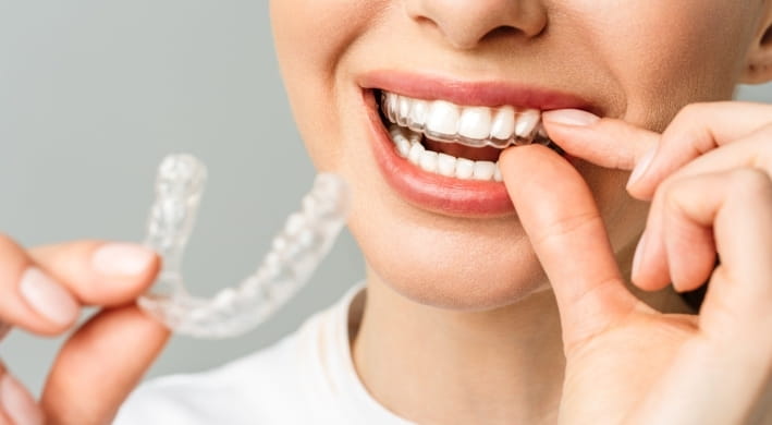 Invisible Aligners